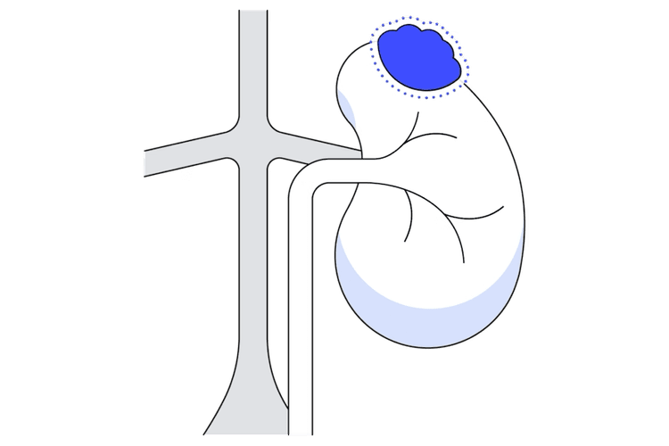 Diagram of a partial nephrectomy