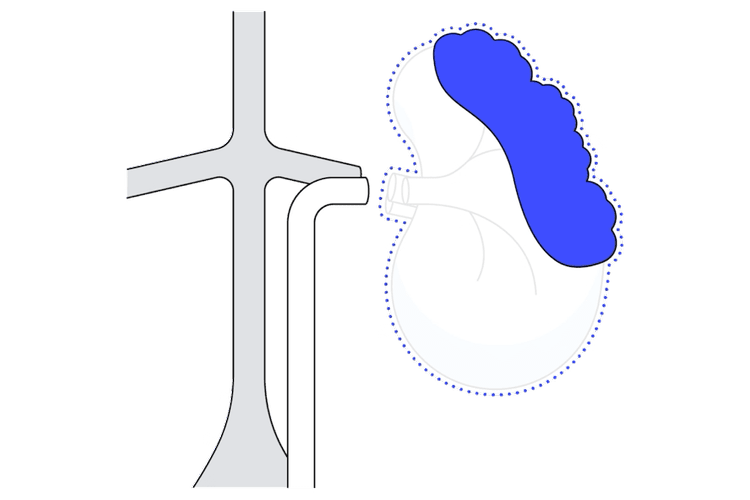 Diagram of a radical nephrectomy